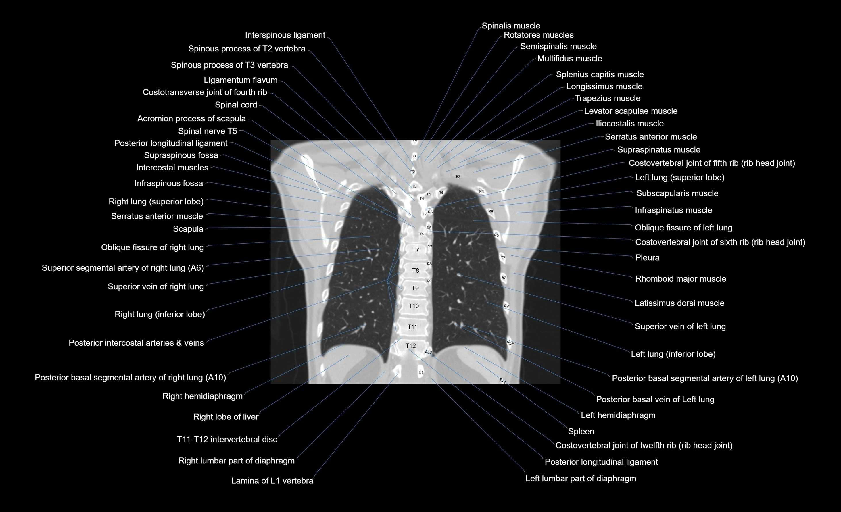 CT chest (thorax) lung window window labelled coronal cross sectional anatomy radiology image-00030.webp